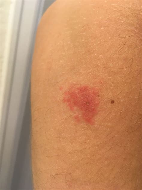 red blotches on skin not itchy